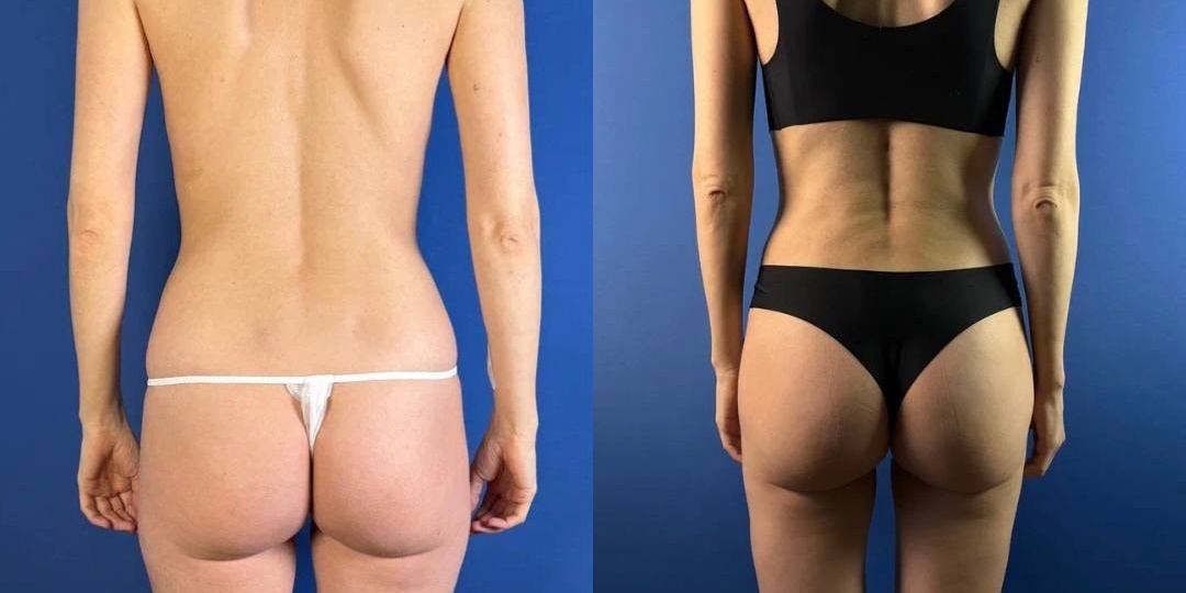 Почему худым сложнее делать пластику, чем полным