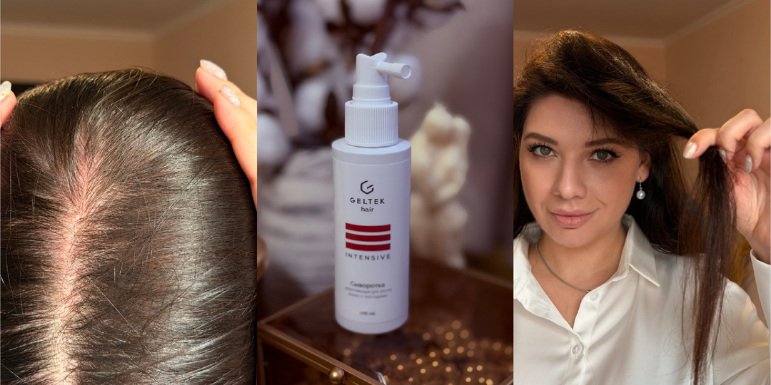 Я лысею. Что купить при андрогенной алопеции