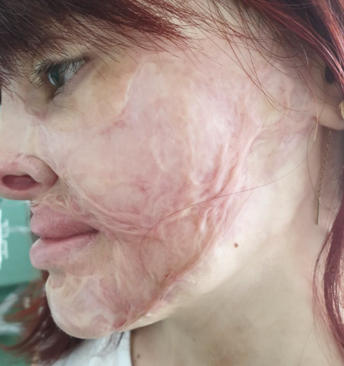 Грубые деформирующие рубцы на лице молодой девушки