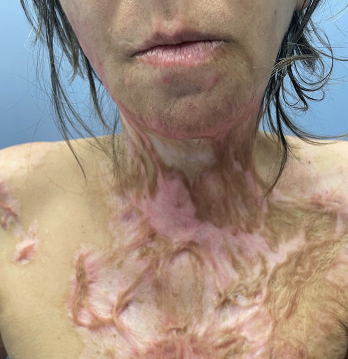 Деформирующие рубцы после ожога