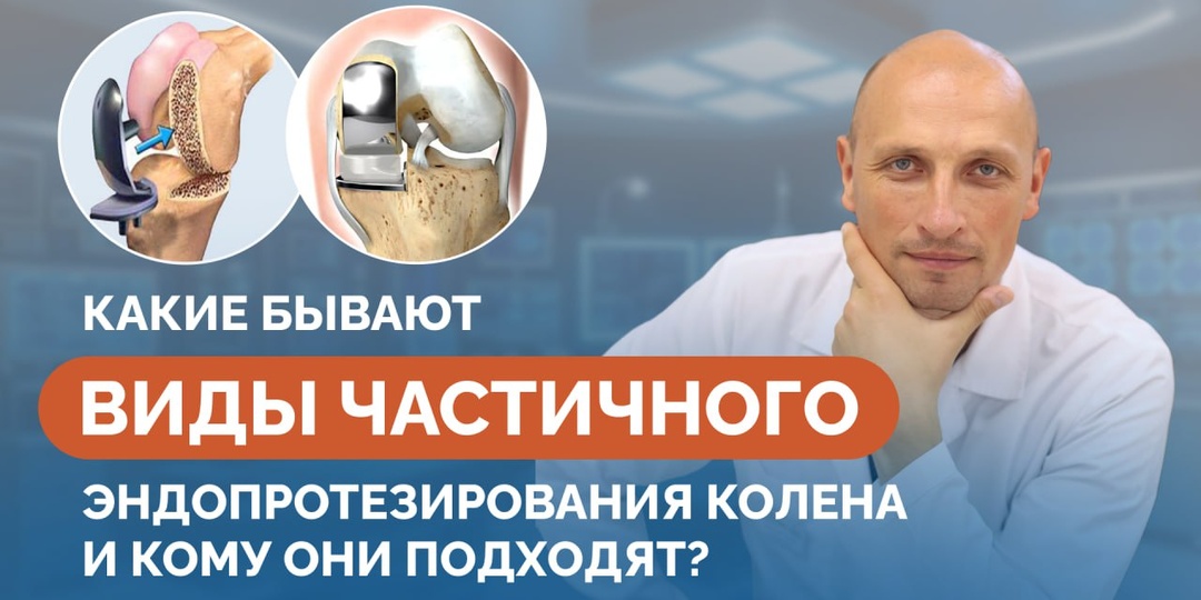 Какие бывают виды частичного эндопротезирования колена и кому они подходят?