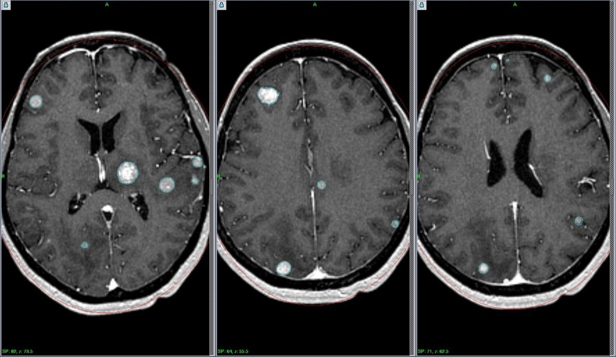 МРТ картина множественных метастазов в головной мозг.