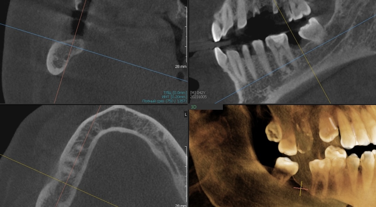 Состояние кости до, 8 наклонена в сторону отсутствующего зуба 7