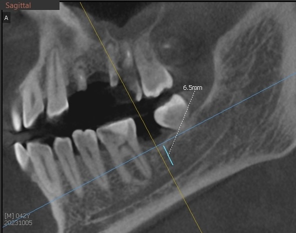 До нижнечелюстного канала мало кости