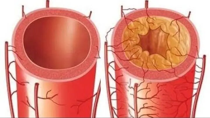 Как понять, что сосуды начинают «засоряться»