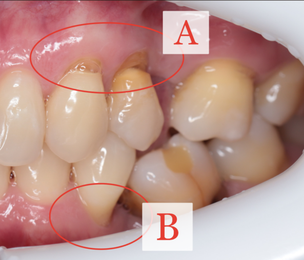 Профилактика рецессии десны. Один пациент - два механизма