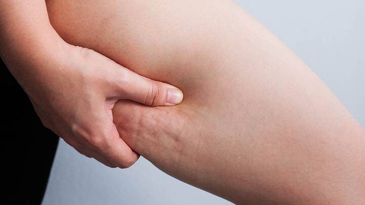 «Локальная травма»: мифы об антицеллюлитном массаже, в которые пора перестать верить