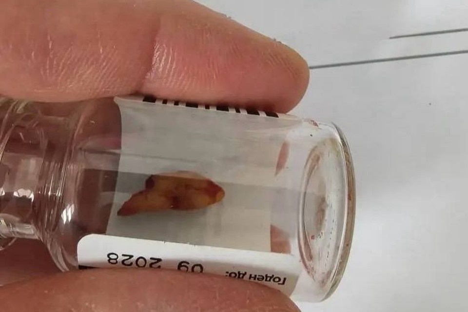    Заведующая отделением Татьяна Смирнова провела ювелирную работу по извлечению «мигрировавшего» зуба. Фото: горбольница Орска