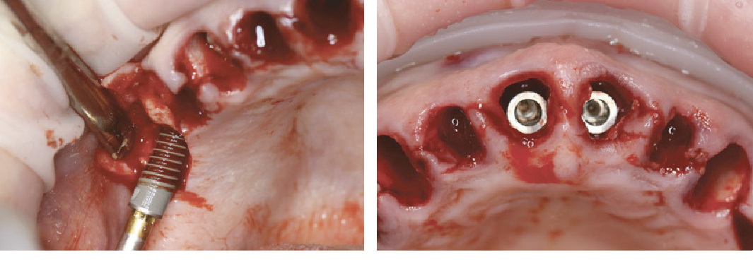 Рис. 1 Введение имплантатов системы blueSKY fast & fixed bredent medical (Senden, Германия) одномоментно после удаления зубов пациенту 1: а) сперва вводятся дистальные имплантаты; б) нёбное положение центральных опор