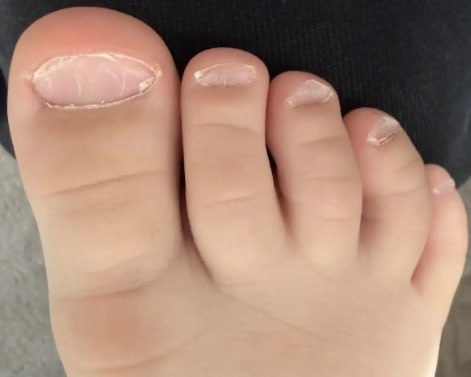 🏥 В Ильинскую больницу обратилась мама 3-летнего мальчика с жалобами на периодические носовые кровотечения, пятно на носу по типу ссадины