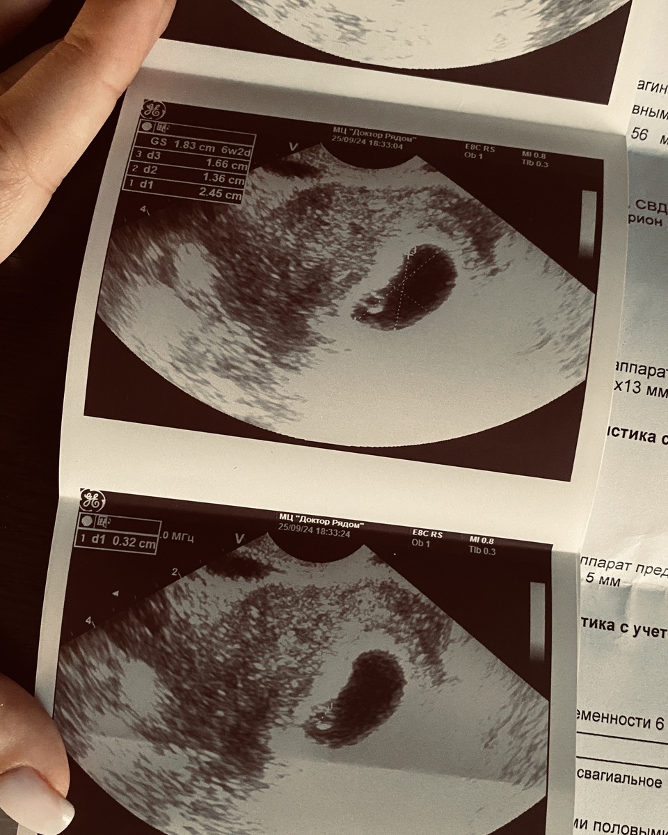 Наше первое УЗИ. Тогда это было просто маленькое плодное яйцо, но для нас — уже целый мир.