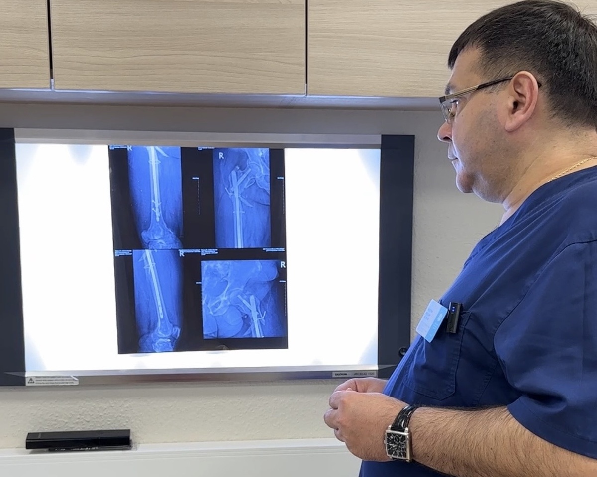 Пациент обратился в ЦНМТ с осложнениями после остеосинтеза: укорочение конечности на 4 см, наружная ротация, а часть металлоконструкций сломалась