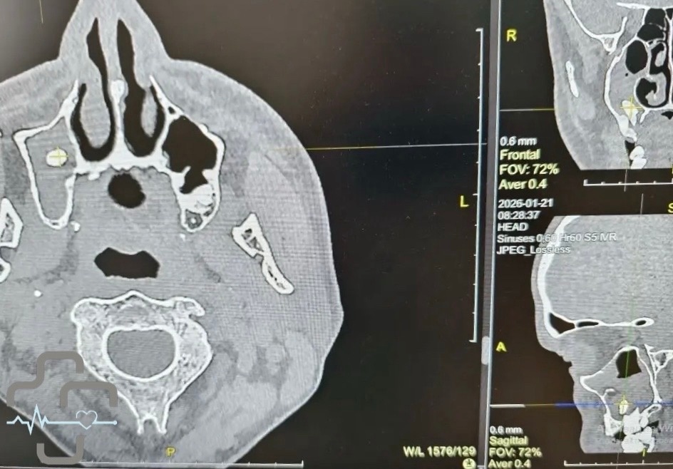    В Орске врачи извлекли зуб из носа мужчины