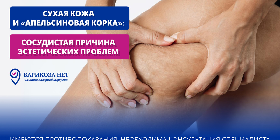 Сухая кожа и «апельсиновая корка»: сосудистая причина эстетических проблем