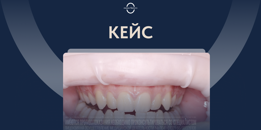 Брекеты в 14 лет?