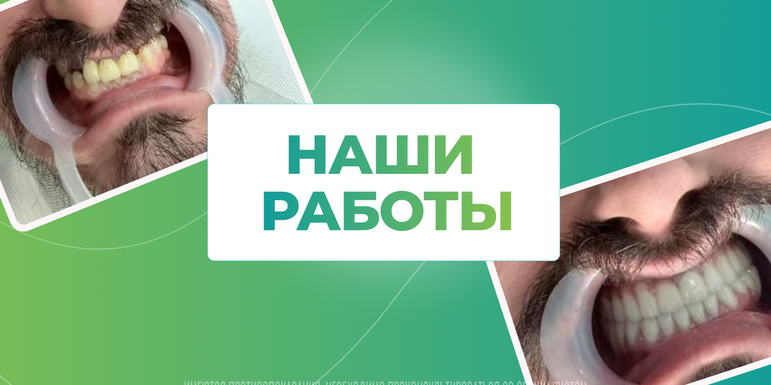 Где и как вернуть красивую улыбку всего за 4 дня