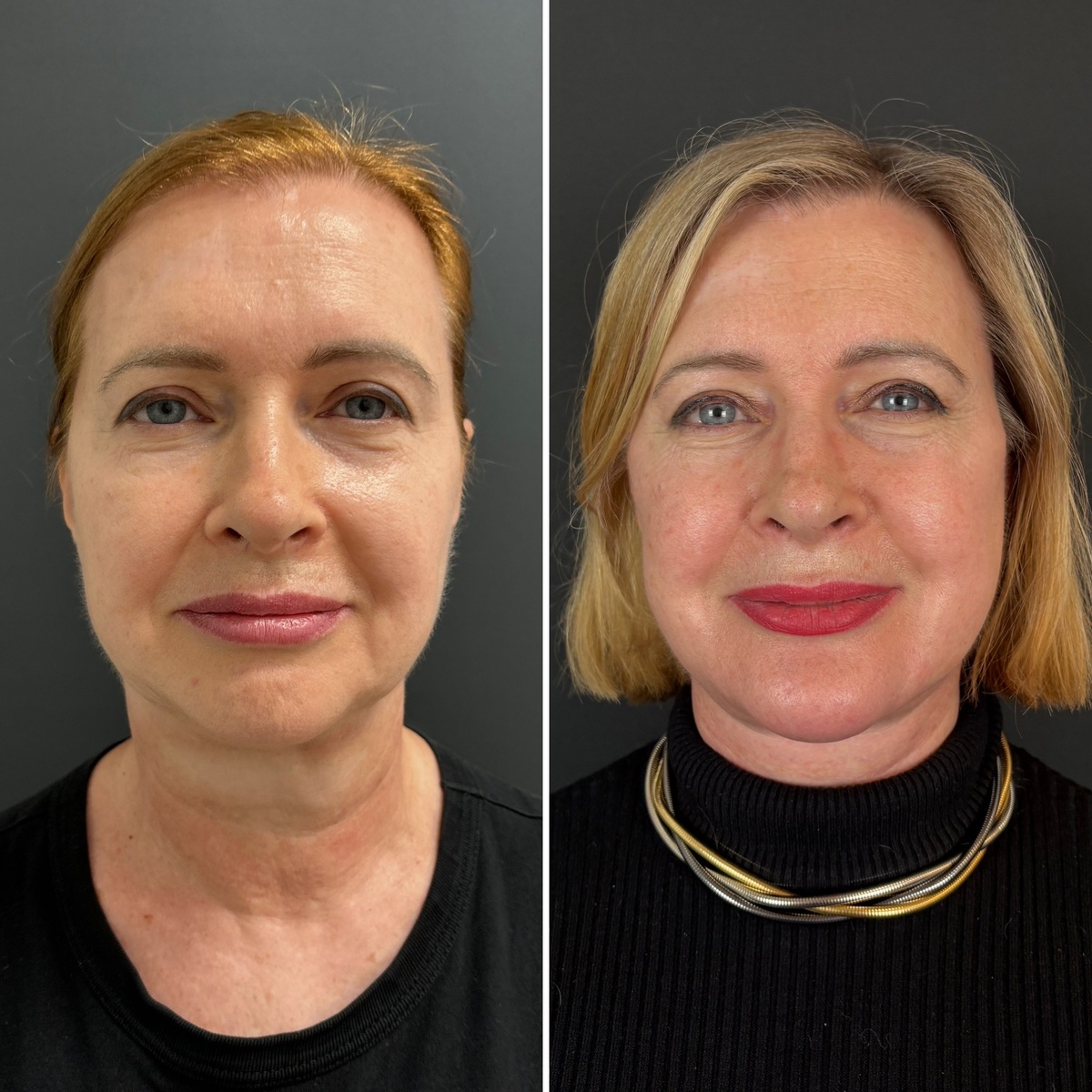 Комплексное хирургическое омоложение лица: слева до, справа- через 7 месяцев после операции. Пластический хирург к.м.н. Т.В. Остринская