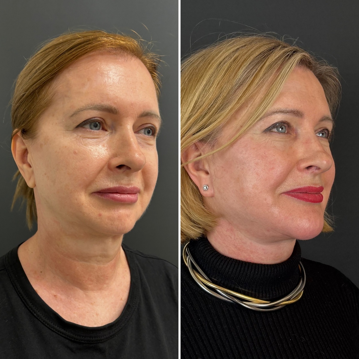 Комплексное хирургическое омоложение лица: слева до, справа- через 7 месяцев после операции. Пластический хирург к.м.н. Т.В. Остринская