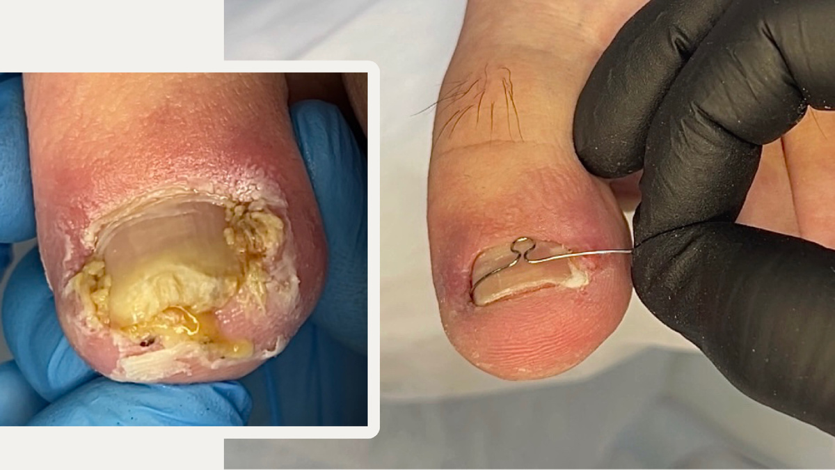 Коррекция вросшего ногтя на стадии гнойного воспаления