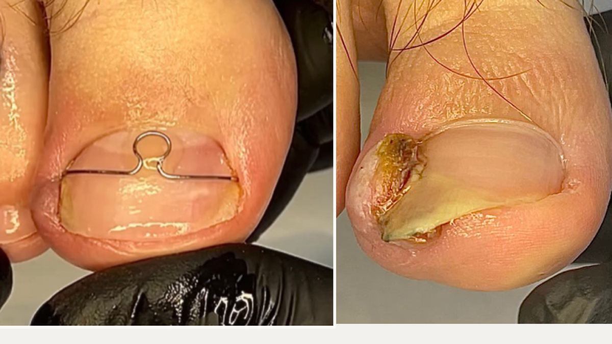 Коррекция вросшего ногтя на стадии образовавшейся грануляции (дикое мясо)