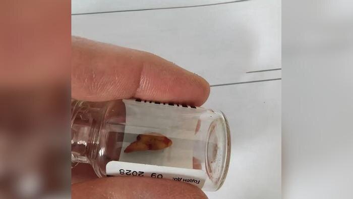 Врачи Орска извлекли зуб из носовой пазухи пациента. Обложка © VK / ГАУЗ «ГБ» г. Орска