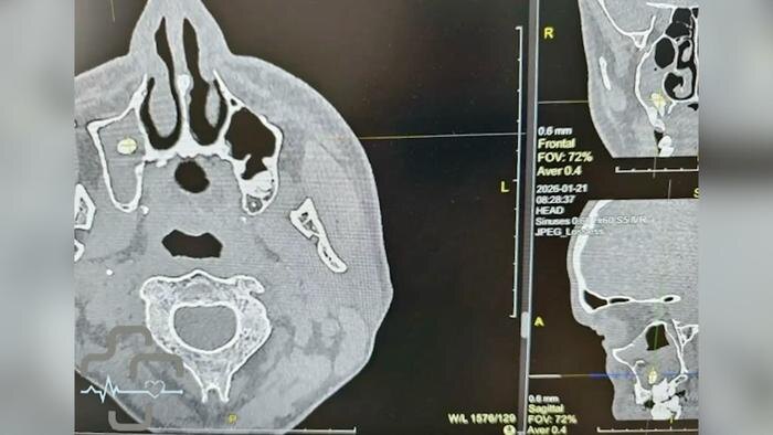 Врачи Орска извлекли зуб из носовой пазухи пациента. Фото © VK / ГАУЗ «ГБ» г. Орска