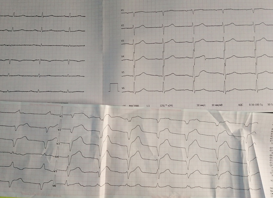 Нижняя ЭКГ снята бригадой скорой помощи. Чёткие признаки переднего распространённого инфаркта. Верхняя ЭКГ снята в реанимации - патологии нет. Пациент "выздоровел".