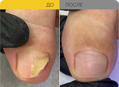 Обработка ногтя при отслоении 