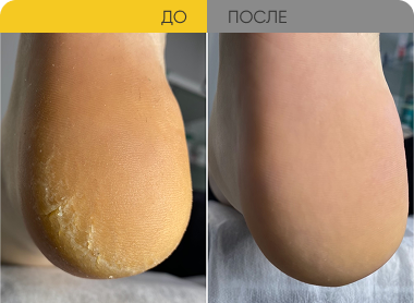 Обработка пяток с трещинами
