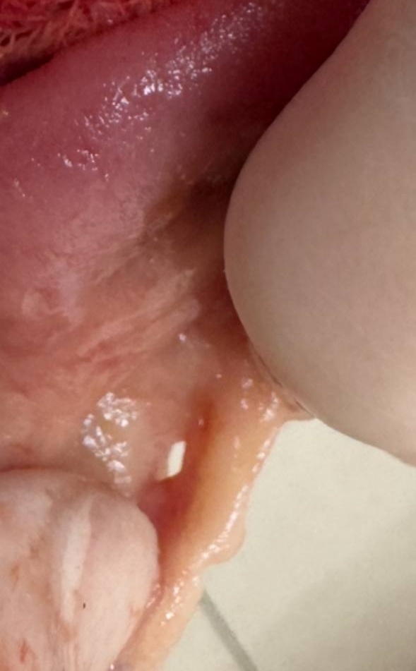 Спайки на кишечнике