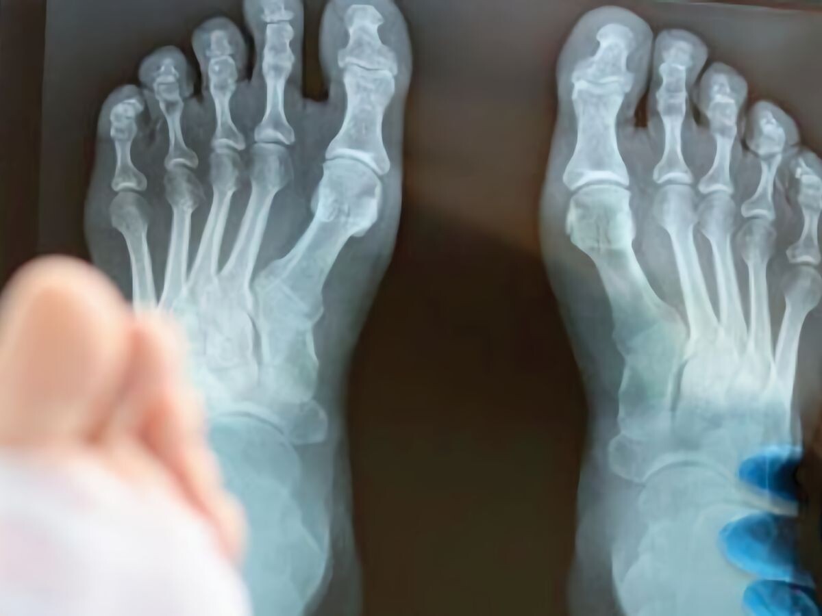    Создан гидрогель для восстановления костей при переломах