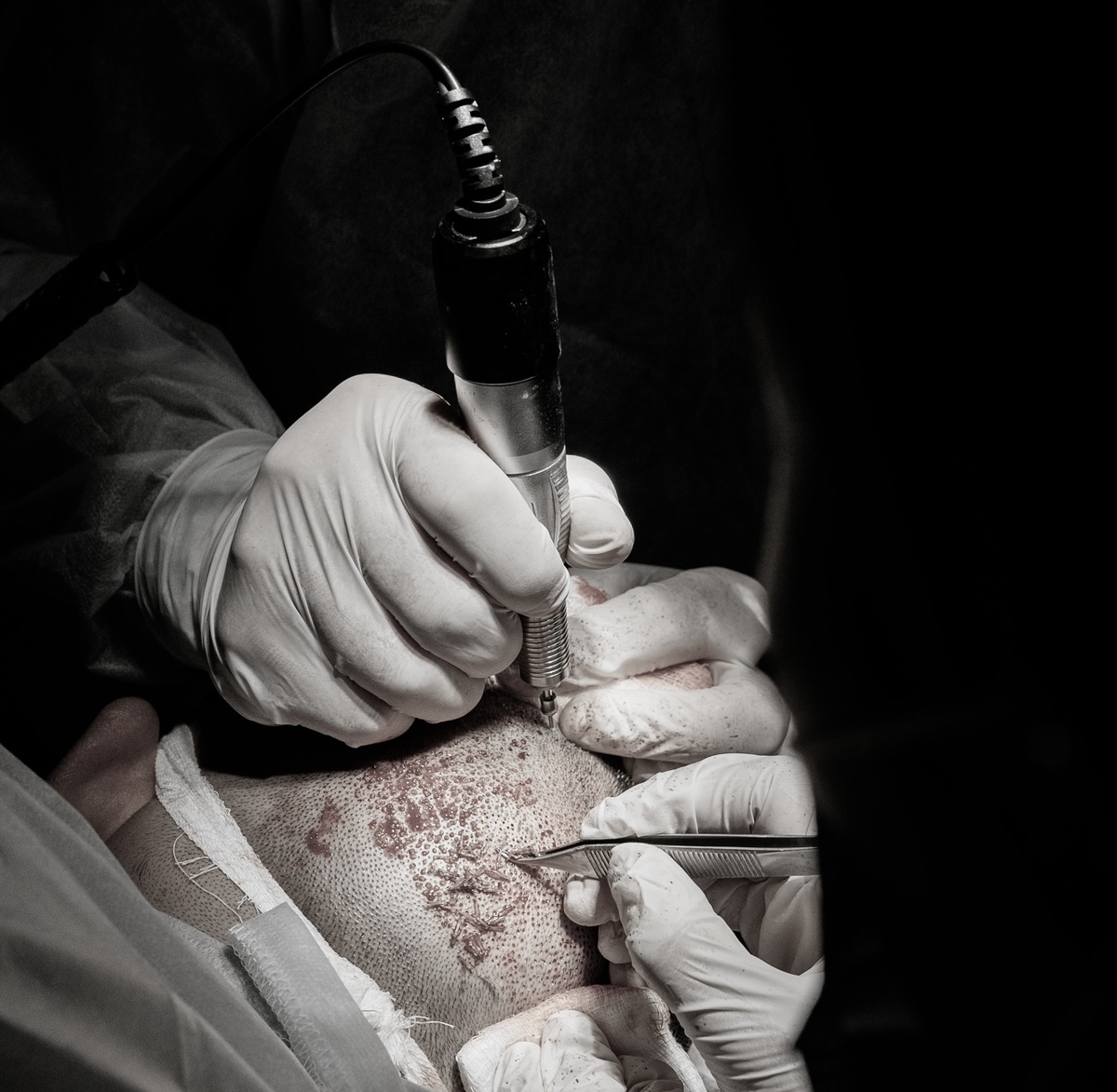 Изображение: микропанч и процесс извлечения графтов