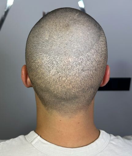 Изображение: донорская зона на затылке