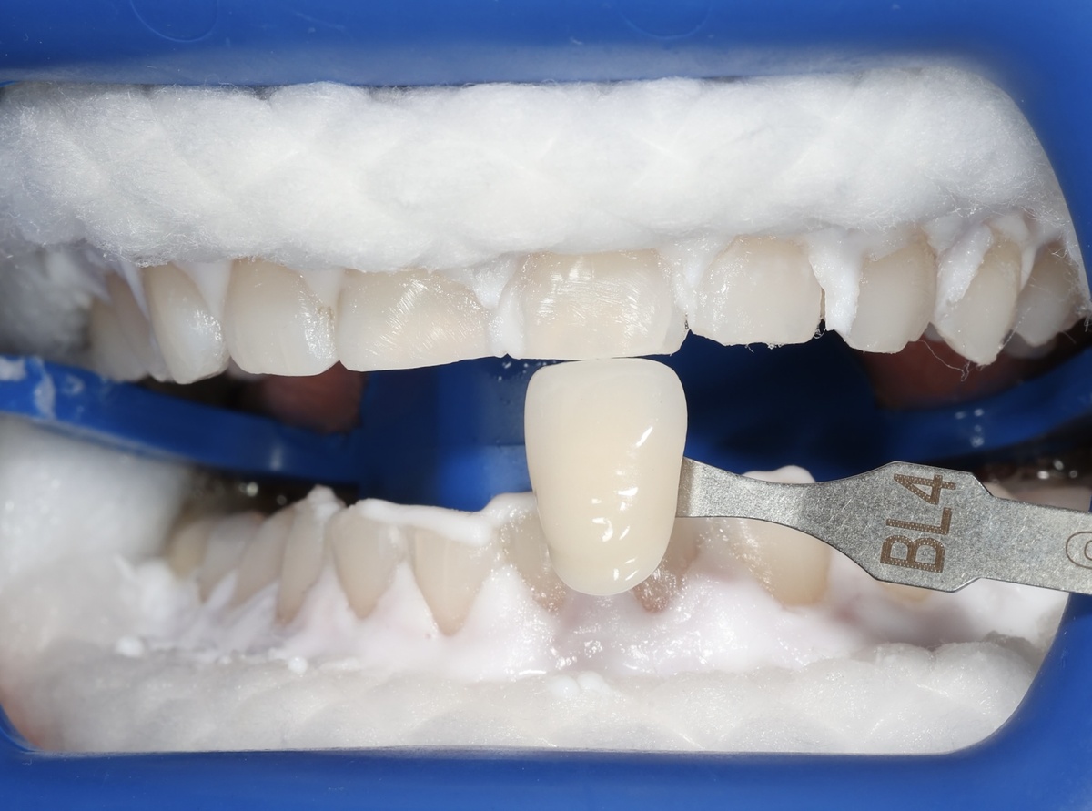 Мои зубы сразу после Zoom 4, даже гель ещё не убрали