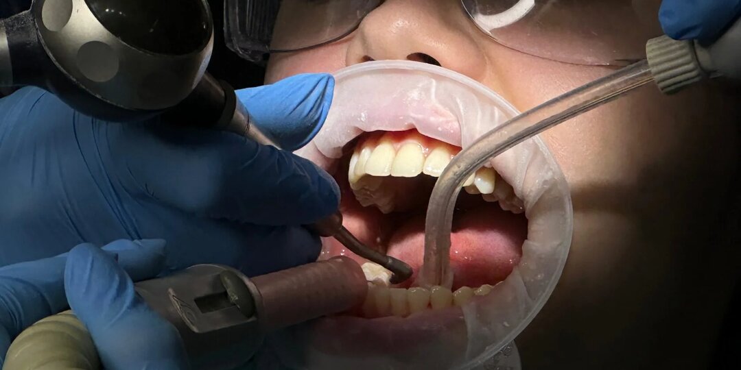 Симптомы пульпита: как отличить его от кариеса