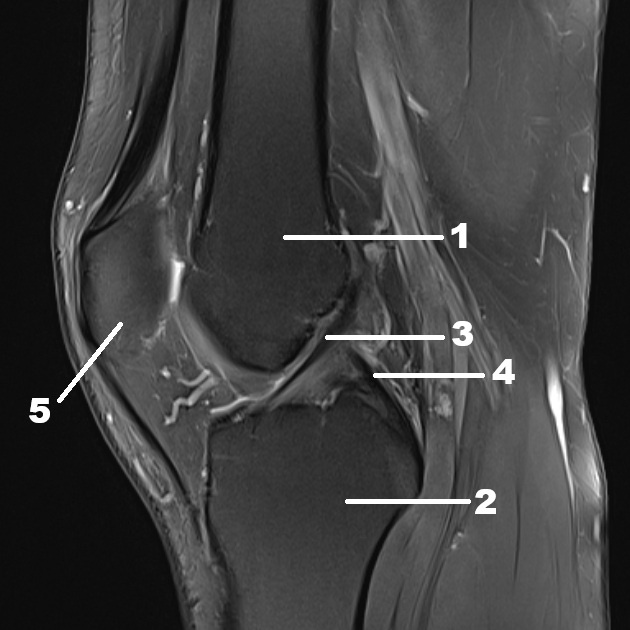 Рисунок 1. МРТ-снимок из личной практики. Нормальная анатомия сустава (26 лет). Бедренная кость (1), большеберцовая кость (2), передняя крестообразная связка (3), задняя крестообразная связка (4), надколенник (5).