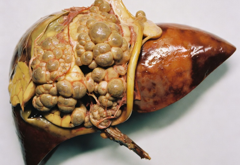 Что принять перед пьянкой чтобы защитить печень?