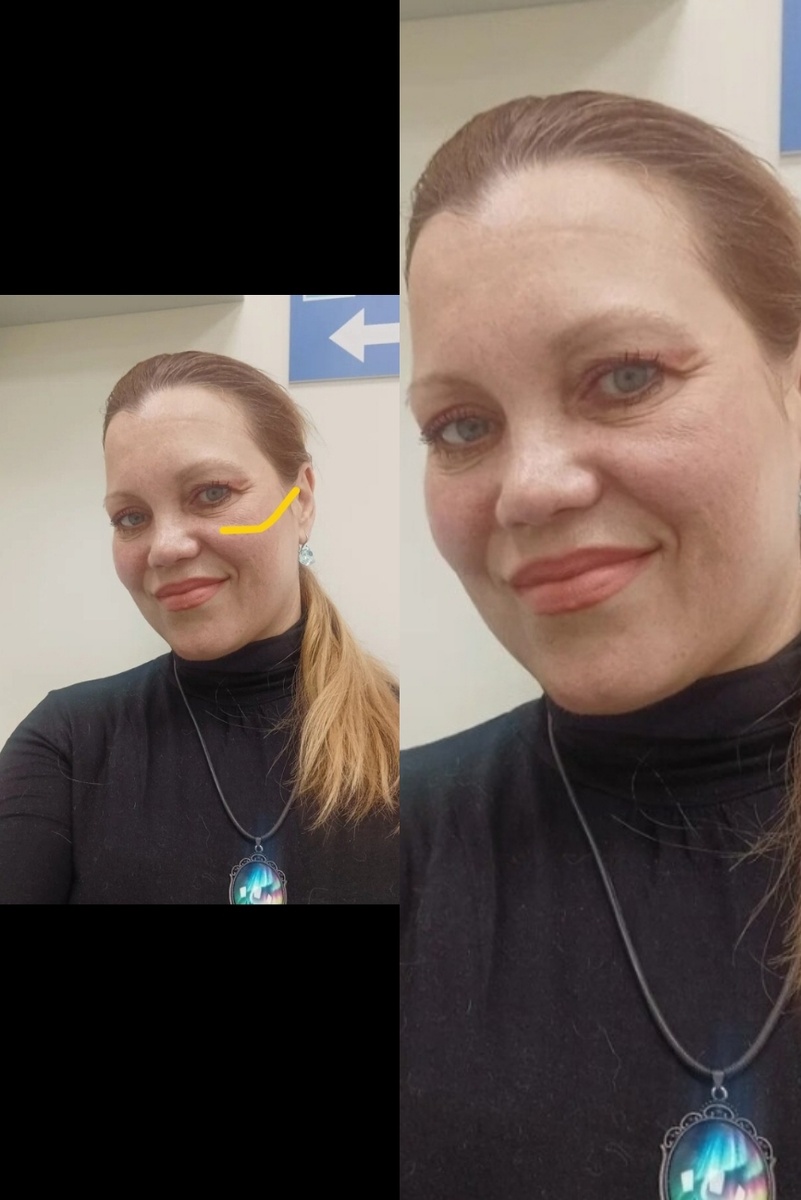 Вот так это выглядит на фото. Я подчеркнула его жёлтой линией. При хорошем освещении это не бросается в глаза в общем контексте вида, но при тенях очень заметно. Плюс с весенним солнцем, если упустить момент, именно на этой скуле проявляется пигментация, что вообще портит вид---выглядит как заживающий синяк