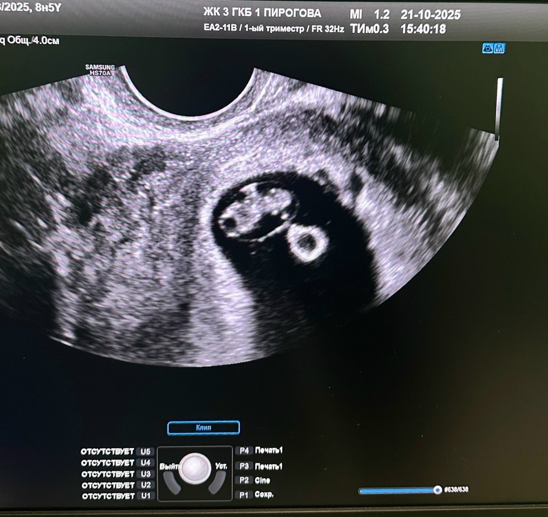 Для меня неожиданностью стало то, что все эти исследования (УЗИ и скрининги) трансвагинальные (да-да, в вас будут тыкать разным и в самые разные места), так что будьте готовы :)
