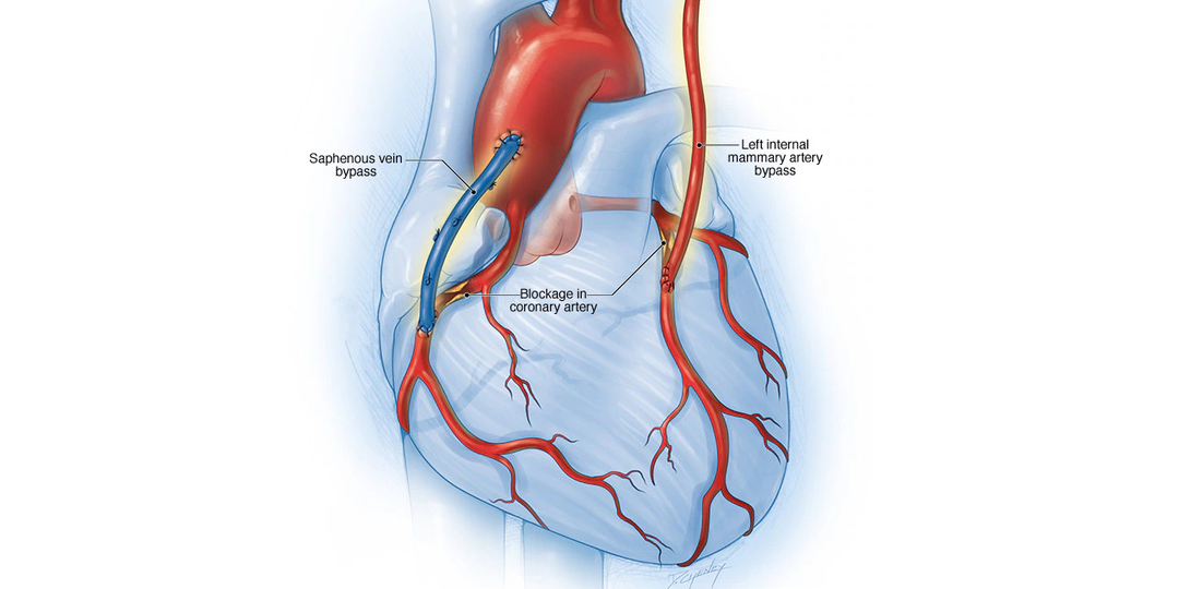 Когда стенты могут оказаться плохим решением?
