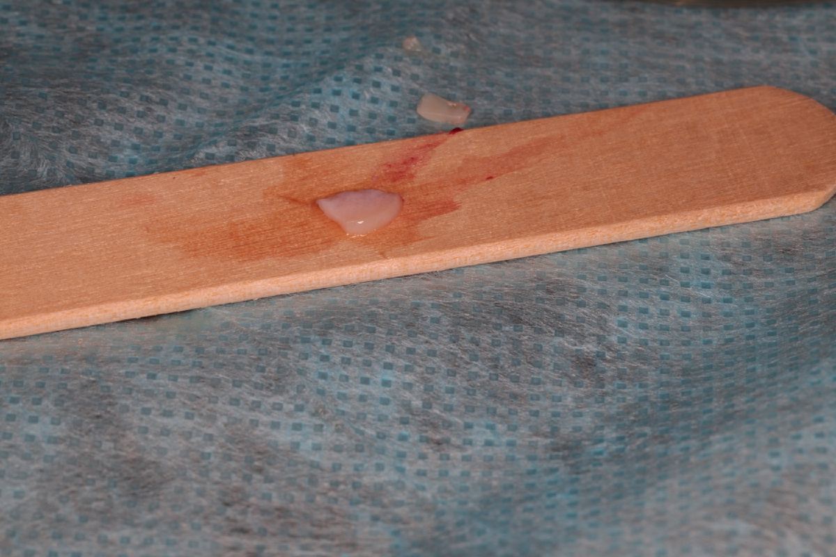 Соединительнотканный трансплантат