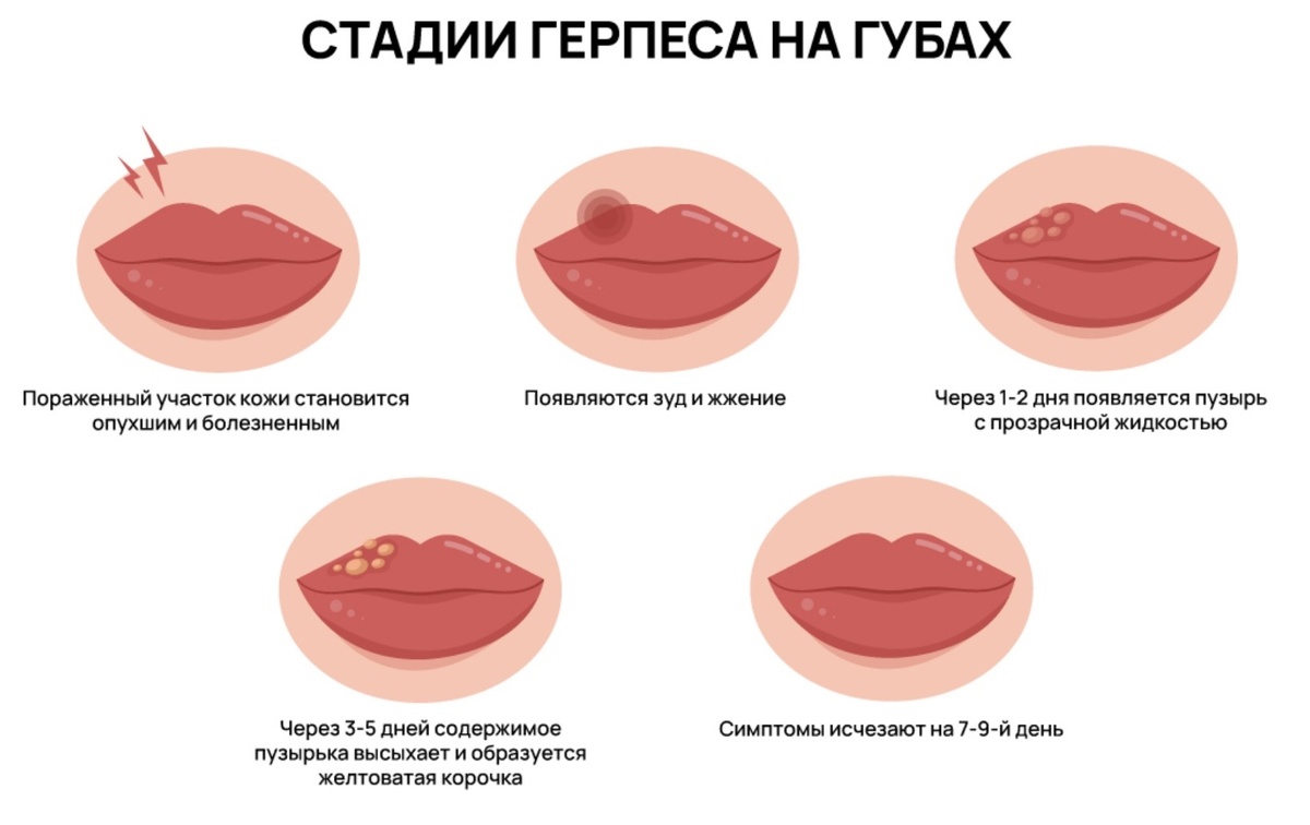 Через сколько дней проходит герпес на губах
