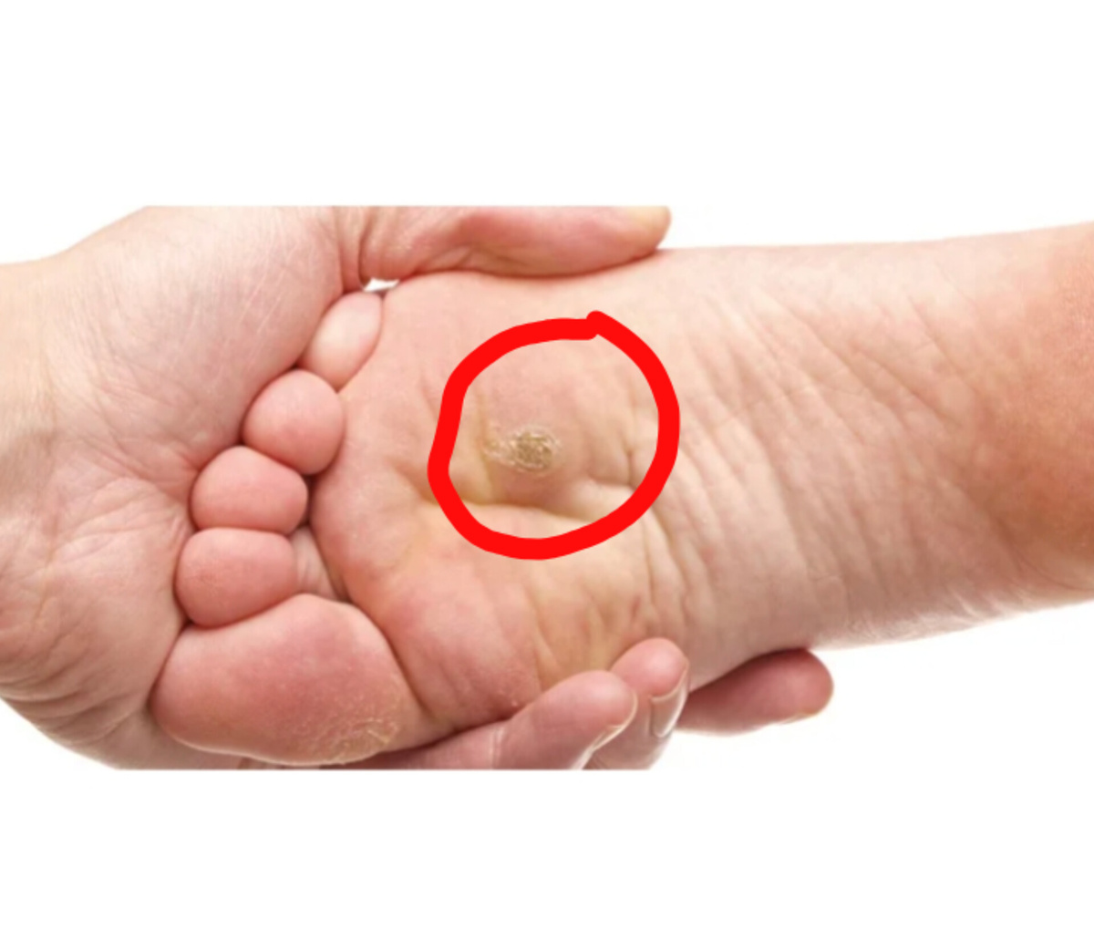 Подошвенные бородавки