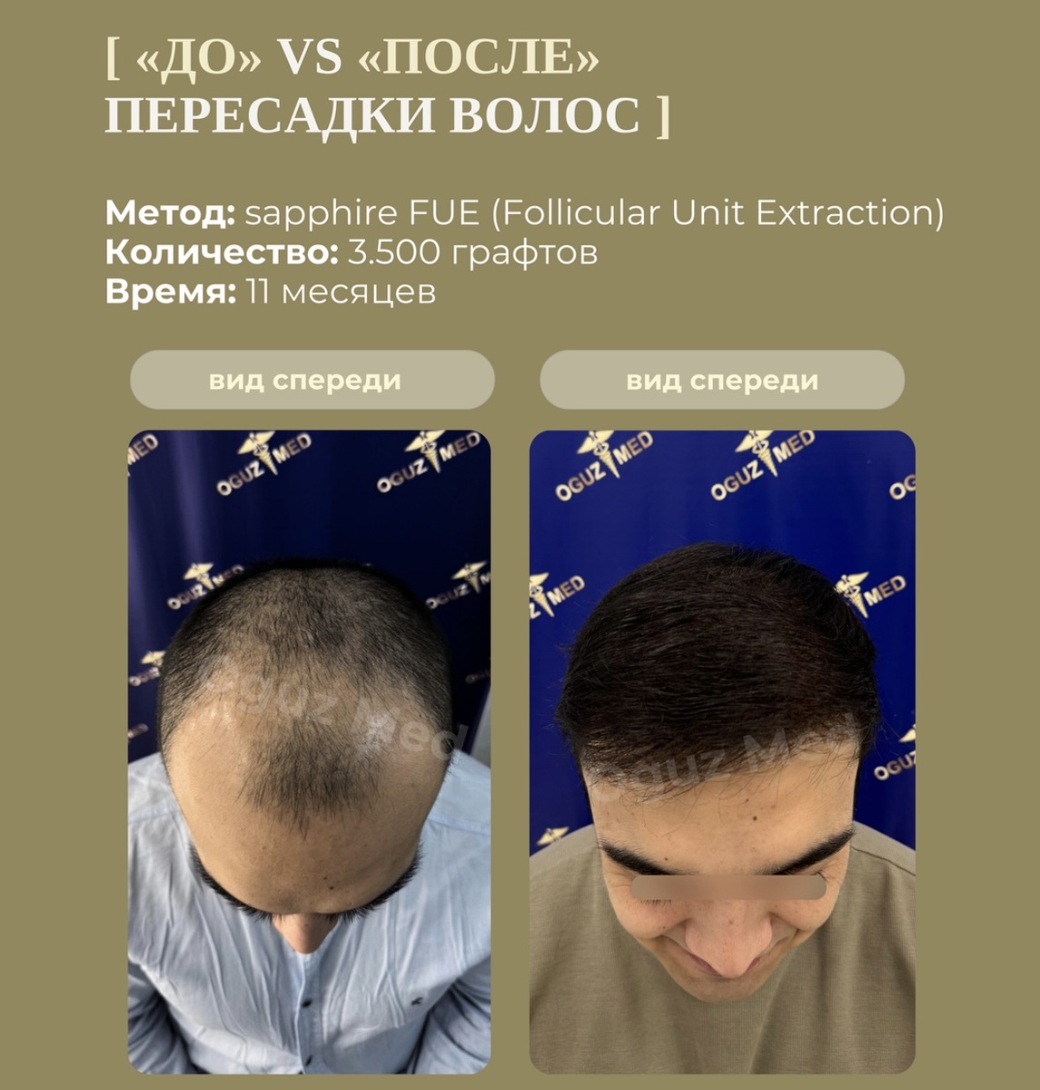 Изображение: Кейс OguzMed, до и после пересадки волос на голову