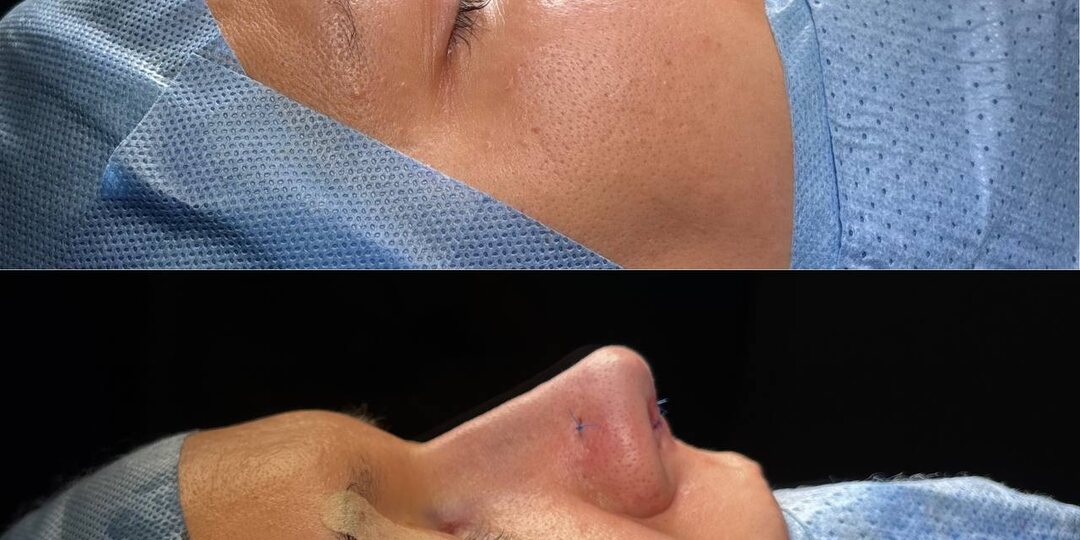 Ринопластика: результат сразу на операционном столе