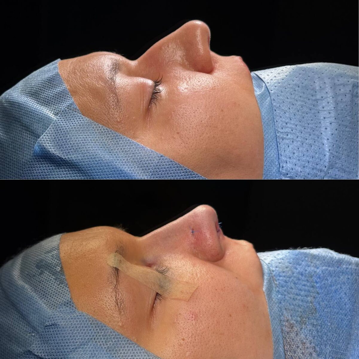 Ринопластика: сверху - до операции, снизу- сразу после. Хирург к.м.н. Остринская Т.В.