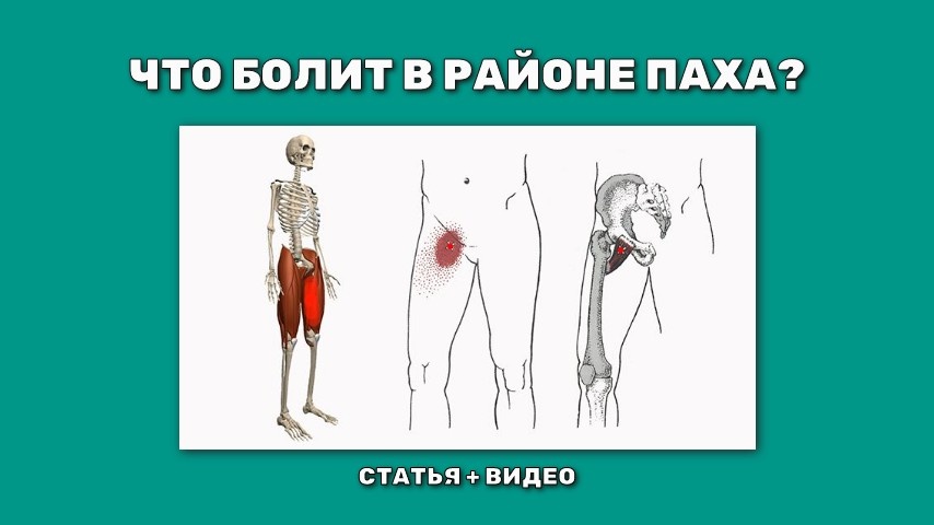 Боли в паху после физической нагрузки.