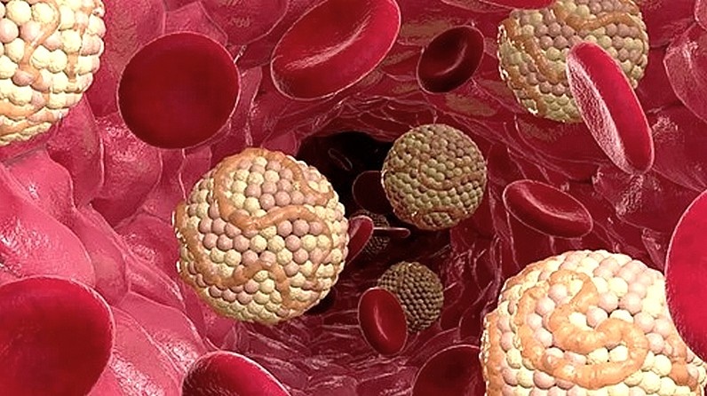 Не допускайте эту ошибку, если у вас повышен холестерин, иначе разовьется атеросклероз