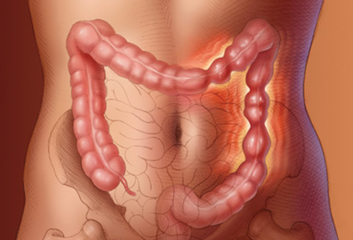 Когда иммунитет «раздражает» кишечник: откуда берётся вздутие после еды