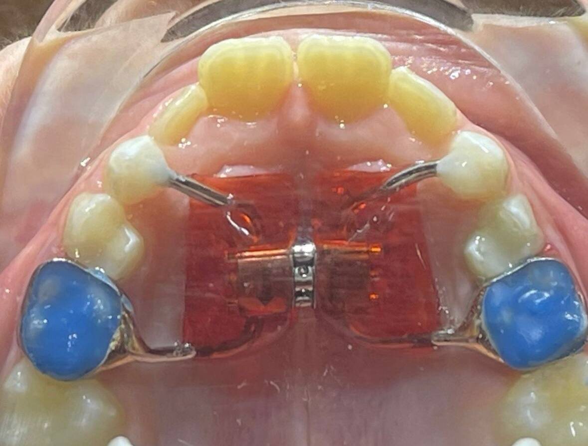 Аппарат Хааса для расширения верхней челюсти
